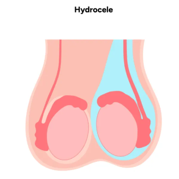 Hydrocele Treatment When Does Scrotal Swelling Need Surgery?