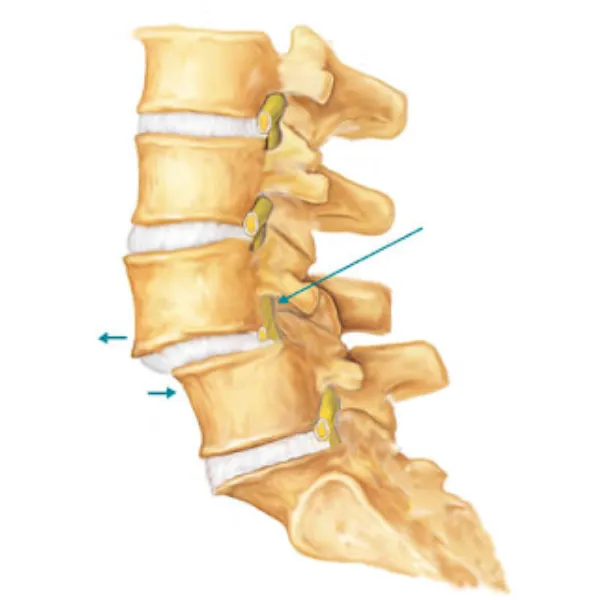 How Spondylolisthesis Can Affect Spine Stability and Movement