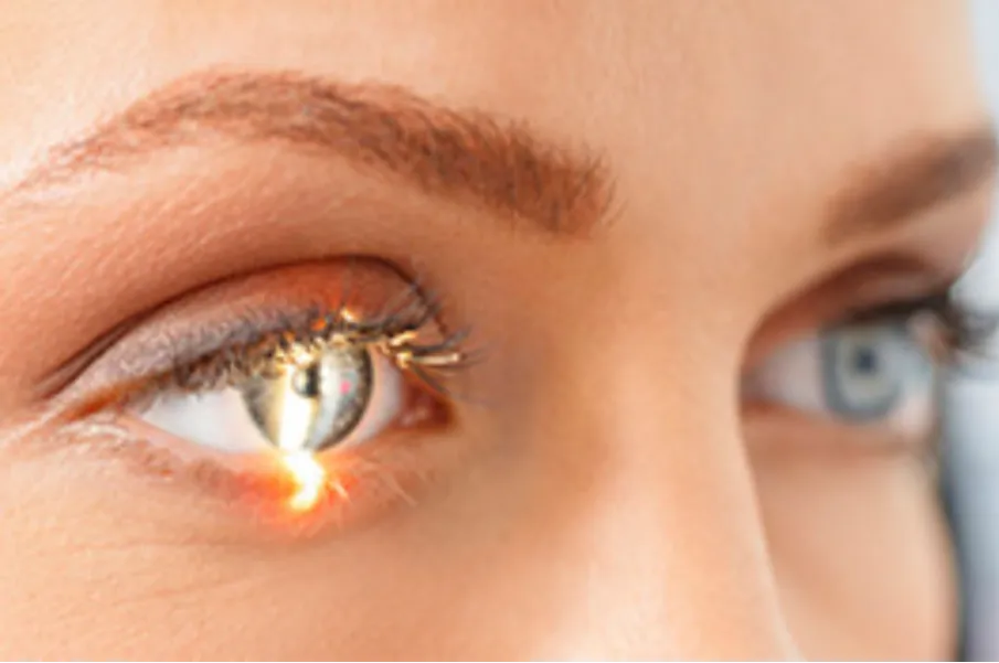 LASIK Suitability Depends on More Than Your Spectacle Number