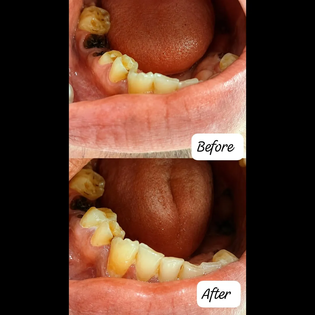 CAP CEMENTATION TREATMENT IN VASHI