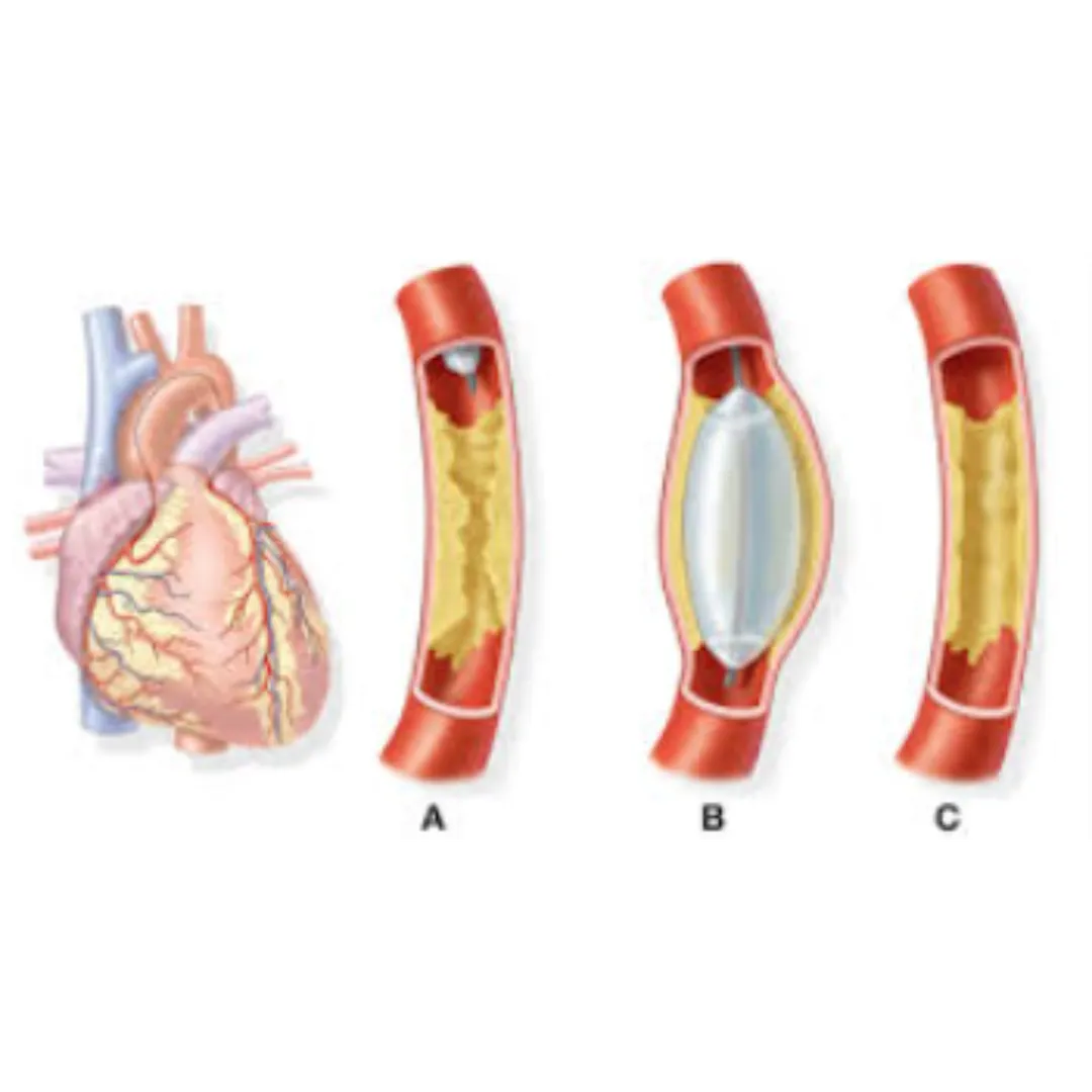 Angiography Explained How This Heart Test Helps Diagnose Blockages
