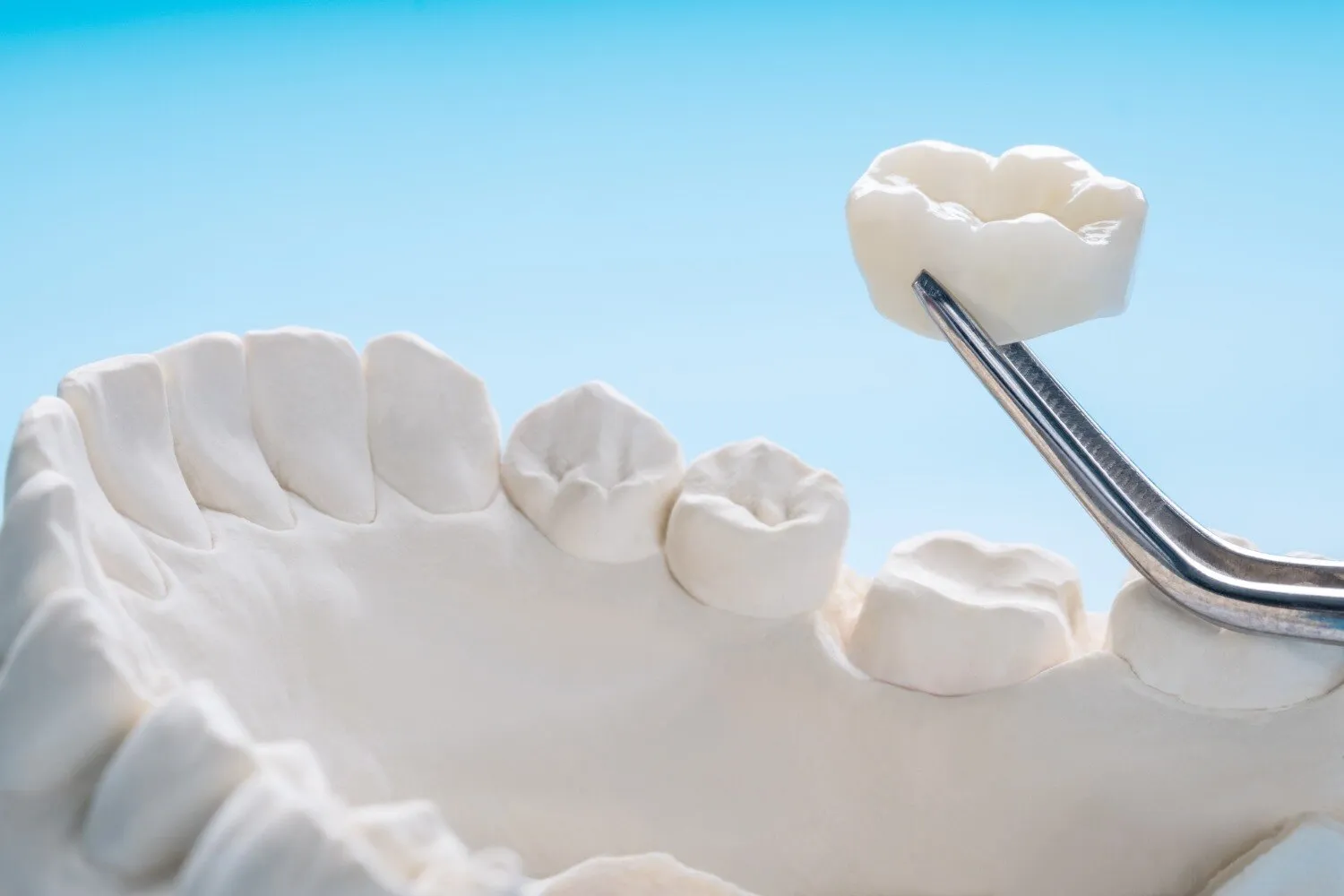When Are Dental Crowns Recommended for Damaged or Weakened Teeth?