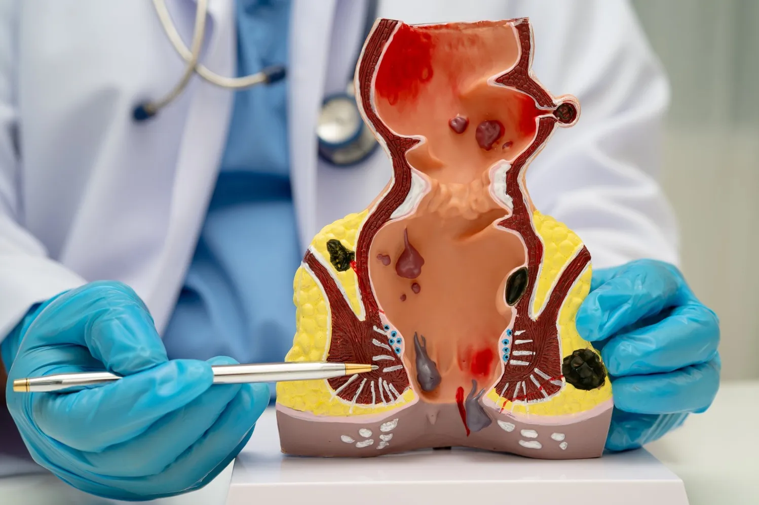 Choosing the Right Piles Treatment When Symptoms Keep Returning