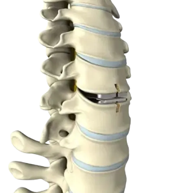 Choosing Cervical Disc Replacement for Selected Neck Disc Problems