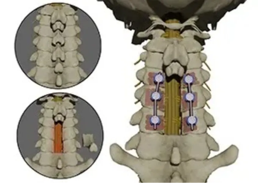 When Posterior Cervical Decompression May Help Spinal Cord Pressure