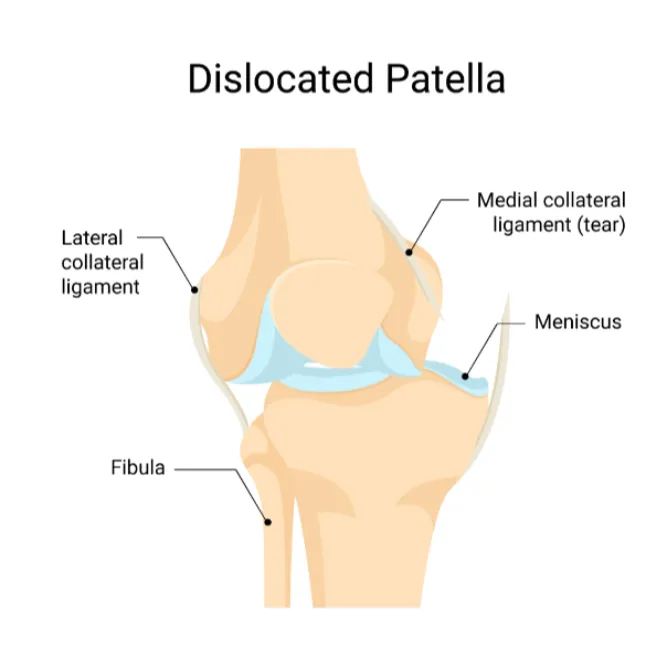 Patella Dislocation Surgeries in Dadar How to Choose the Right Specialist Care