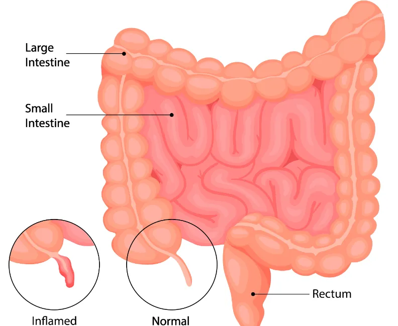 Appendix Surgery Warning Signs, Diagnosis and What Happens After an Appendectomy