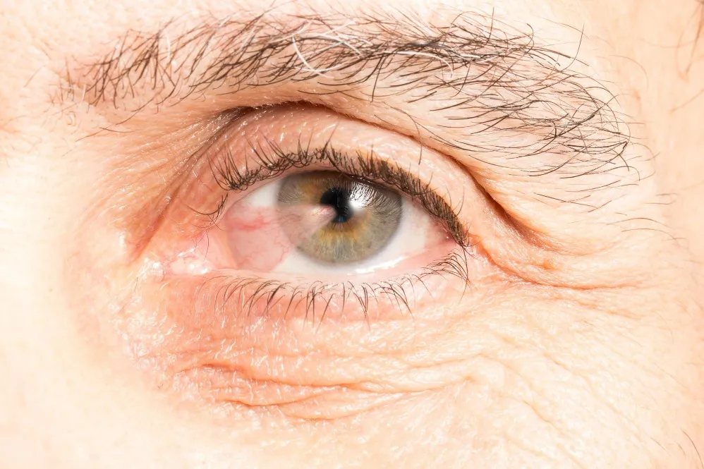 When Eye Surface Changes Make Pterygium Management Worth Considering
