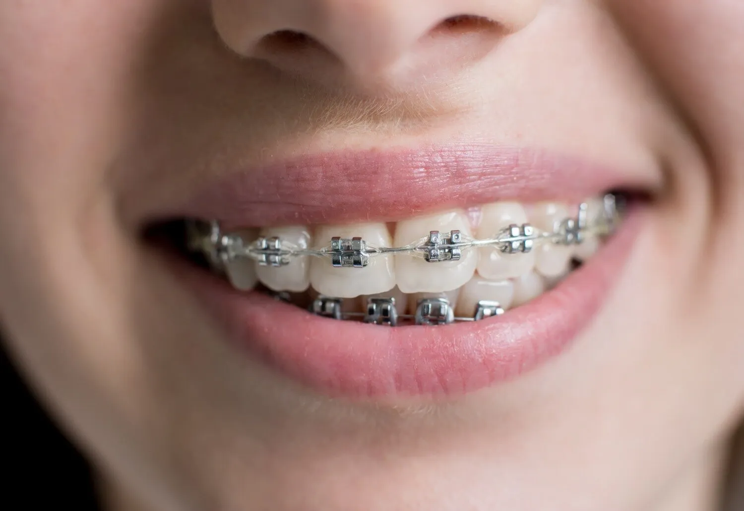 Dental Braces for Crowded Teeth: When Is Orthodontic Treatment Recommended?