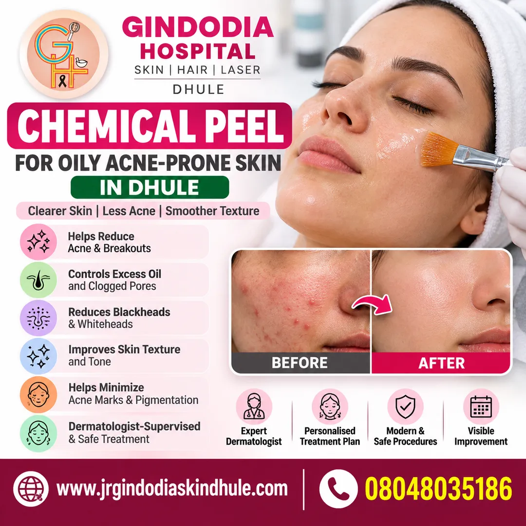 Chemical Peel for Oily Acne-Prone Skin Dhule | Gindodia Hospital