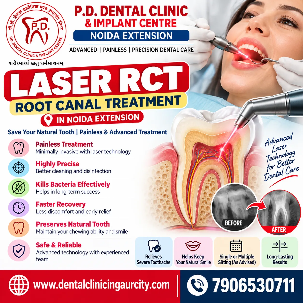 Laser RCT in Noida Extension | Root Canal | P.D. Dental Clinic