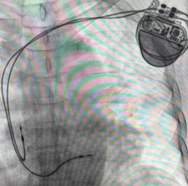 Pacemaker Implantation for Heart Rhythm Problems Understanding the Procedure and Recovery
