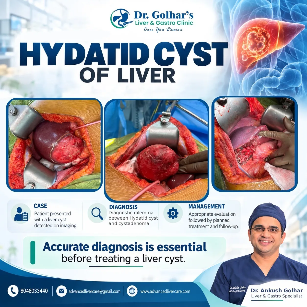 Hydatid Cyst of the Liver: Why Accurate Diagnosis Matters