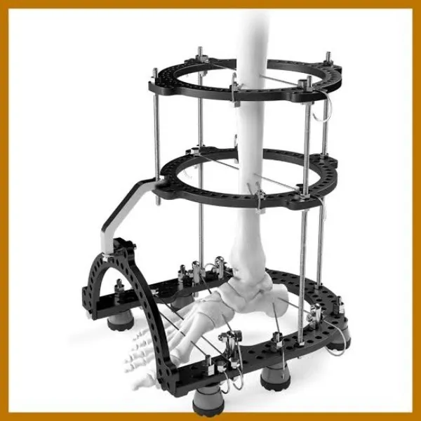 External Fixator System in Nagpur – Khurana Surgicals