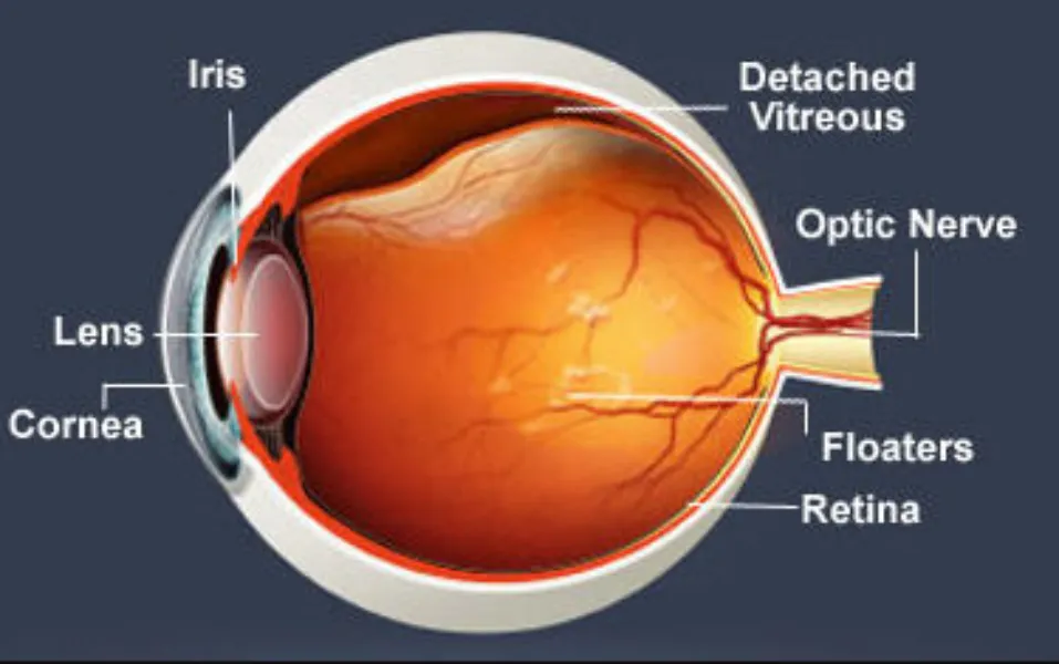 Flashes Floaters May Signal Changes Inside the Eye