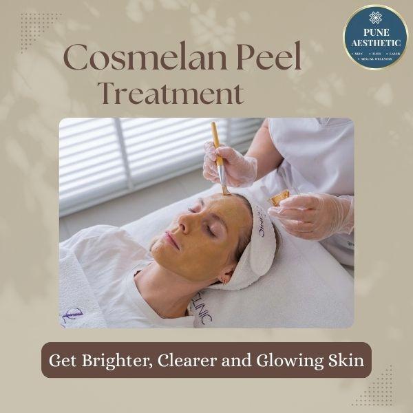 cosmelan peel treatment for hy