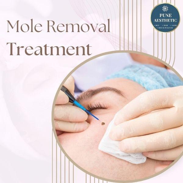 mole removal