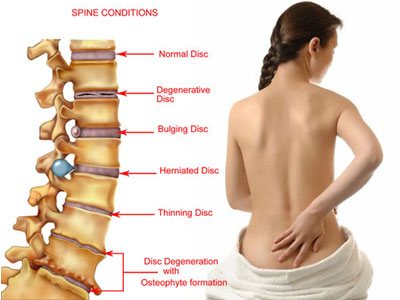 HOMEOPATHIC MEDICINES FOR BACK PAIN
1 RHUSTOX : violent pain in back as if broken, pains cold damp weather , bed in, pains are relieved by movement , pressure hot applications
2 RUTA : pain in nape , back , loins.back ache is better by pressure lying on back.acts upon periosteum, cartlages.
3 HYPERICUM:usefull in compressed injuries punctured wounds.pain in spine due to concussion, injury to coccyx.jerking twitching of muscle. Usefull in radiculopathy, myelopathy.spinal canal stenosis, disc compression
4 CALC FLOUR :pain in lower part of the back, fullness burning pain. Pains due to early degeneration , caries necrosis of the discs.pains after operations.tendency to form adhesions, tumours in spine. INDICATED IN SPINAL TUMOURS, LUMBAR SPONDYLOSIS, ANKYLOSING SPONDYLITIS.
5 NUX VOMICA:burning pain in back 3 to 4 am
6 Cervico brachial neuralgia, touch Must sit up in order to turn in bed.
7 KALI CARB :sharp stitching pains.back feels stiff , weak, burning pain sweat over back.pain from hip to knee. Pains cool climate.SUITED TO BACK PAIN IN PREGNANCY
8 GUIACUM :chief action on fibrous tissue, adopted to rheumatism, gout Stiffness in back , lower limbs.stiffnewss in neck sore shoulder .left sided sciatica.pains motion , cool climate, touch
9 GAULTHERIA :suited to sciatica , neuralgic pains.neuralgia associated with gastralgia.
10 GNAPHALIUM:sciatica associated with numbness.rt sided sciatica.
Back pain >resting on back
11 CAUSTICUM:stiffness between shoulders , dull pain in neck, lt sciatica with numbness.contraction of tendons.unsteady walking
12 SEPIA :weakness in small of back restless in all limbs, back pain before menses
Back pain associated with pelvic inflamtory diseases