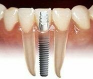 Dental Implant

Dental Implants are artificial devices used to replace missing teeth. Implants come in many different sizes and shapes and they are placed into the bone to act as support for a prosthetic crown. These are the most modern method of replacing missing teeth. They are basically substitutes for the natural tooth roots. They are made of titanium and are usually cylindrical in size.
BENEFITS
Dental implants have given countless patients many amazing benefits including
Natural tooth like feelingImproved appearanceImproved comfortImproved speechEat better, enjoy more foods, better nutritionConvenienceImproved self-esteem
Dental implants are a great value for your investment. Implants look much better, and feel better, than traditional removable bridges, and offer the same force for biting as bridges that are fixed in place. Implants will last your lifetime.!!!
PROCEDURE
STAGE ONE -
The Implant Procedure
The implant procedure is the same whether one or all teeth are missing. In this example, there is only one missing lower tooth. For the purpose of demonstration we will assume the patient is healthy and is a candidate for this procedure.
Placing the Implant
Involves the placement of specific size and shape implants at strategic locations in the mouth. This is performed under local anaesthesia and the entire procedure takes approximately 45 minutes to one hour. Usually the healing is uneventful as the patient is on the prescribed drugs. Implants can also be placed immediately after extractions.
The Healing Process - Osseointegration
The healing process takes two to three months. This is the amount of time it usually takes for the implant to become part of the lower jaw, commonly referred to as osseointegration. ( osseo - bone ; the bone starts forming around the implant and the implant gets integrated into the bone tissue).
STAGE TWO-
Attaching the Abutment
Today's technologies often include zirconium abutments attached to the implant post, to assure that the new porcelain tooth possesses translucency properties similar to a natural tooth.
Placing the Crown
After impressions are taken a crown is made and shaded to match your existing teeth. The crown is then slipped over the post and cemented.
The Completed Implant
The final prosthetic crown appears as a natural tooth.
Applications of Implant Dentistry
In many cases, dental implants are incorporated into an overall treatment plan that might focus on the replacement of several teeth. Some patients have the option of replacing each affected tooth with a new implant, depending upon the condition of the bone. Other treatment plans may require implants for anchoring bridges and dentures.