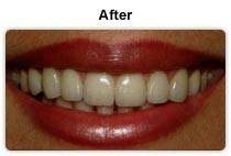 Smile Makeover
Beautiful Smiles Make the Difference
Smile makeover patients at our practice love their new smiles and find themselves smiling a lot more after treatment. Your smile is one of the first things people notice about you. A smile makeover is a cosmetic dentistry treatment that will provide you with a beautiful smile. If you have a beautiful smile, natural-looking smile, you will smile more, project self-confidence, be more positive in all aspects of life. Whatever concerns you have about the size, shape, placement, or color of your teeth, smile makeovers can fix almost any problem you present: gaps, chips, stains, discoloration, missing teeth, crooked teeth, short teeth, oversized teeth, slanting teeth, misaligned teeth, tooth grinding, gummy� smiles, receding gums, unnatural or ageing dental work, and old silver fillings can all be corrected with our state-of-the-art, expert procedures.
Patients come to our clinic from far distances to take advantage of the experience and artistic expertise offered by both dentists in our practice. The first step in a smile makeover is the examination appointment.
A smile makeover will improve the look of your smile, as well as restore any dental problems that you have, adjust your bite, and reset the muscles in your jaw so that you will look good and feel great.
