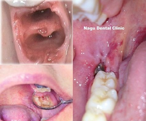 Dry Socket Natural Treatment Dry Socket Natural Treatment