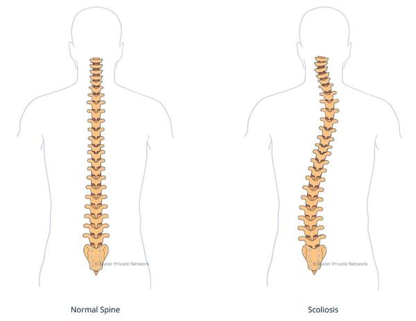 scoliosis correction exercises