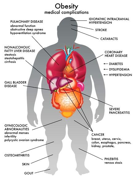 Several health hazards and social disabilities are associated with obesity. Increased mortality is associated with increased body weight. A high rate of mortality results from heart disease, diabetes mellitus, gallbladder disease, high blood pressure, and cancer.
