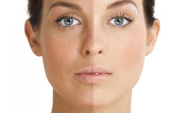 Melasma treatment
What is Melasma?
Although melasma is not painful and little detrimental to your overall health, darker skin symptomatic pieces can have a major impact on your appearance. The Melasma is not always easy to treat, especially due to exposure to the sun.
The Melasma is a medical problem that makes the pigment in some segments of the skin getting darker. It usually occurs on the cheeks, chin, forehead and upper lip, but can occur in any area of skin exposed to the sun. Melasma occurs more often in women and in people with darker skin tones. When melasma appears during pregnancy, it is known as the “pregnancy mask” and is called chloasma.
Causes of melasma
The exact cause is unknown, but genetics (of family history of melasma), female hormonal activity, photosensitivity and exposure to the sun are known factors associated with the onset of melasma.
Guidelines
The best treatment is less invasive work and, in the case of melasma , is the use of topical creams. Before starting the treatment is important to understand that melasma is developing gradually and the treatment will also take time, usually usually takes months, especially if it is related to hormones. If appears during pregnancy or while they ingest hormones, discoloration will disappear when you stop taking medications with hormones. Stop using skin care products that irritated because this will make the melasma worse.
Avoid sunlight
No matter which treatment you choose, you should avoid sun exposure. All sun waves can cause skin discoloration and affect treatment, so be sure to wear a sunscreen filter and high index every day, even if the weather is cloudy. The Ministry of Health and dermatologists recommend using sunscreen that protects against UVA and UVB rays and has a factor of 30 and above. Solar filters, zinc oxide and titanium are more effective than disruptive chemicals.
Topical creams
Creams with chemical bleaching bases are the main treatment. A chemical known as hydroquinone is usually effective. The patient always starts with the lowest concentration to check the risk of side effects such as skin irritation and increased pigmentation, and then you can achieve an increase in higher concentrations. It is present on the market of drugs containing hydroquinone (HQ), tretinoin and a combination of HQ. These are issued by ordinance.
Exfoliation
The chemical peel, laser peeling are used to remove the outer layers of the skin. The theory is that the new skin will not be of the hyper pigmentation type, the melasma disappears so as to leave the new skin. Chemical peels usually take less than an hour and the side effects (redness and pain) will depend on the depth of the skin. Microdermabrasion the surface is superior because it removes dead skin with small crystals or other abrasive materials. The laser uses beams of laser light to remove cells from the surface of the skin. Laser treatments require local anesthesia, sessions last between 30 and 90 minutes and result in swelling and redness. Note that this swelling may have a side effect of hyperpigmentation,
