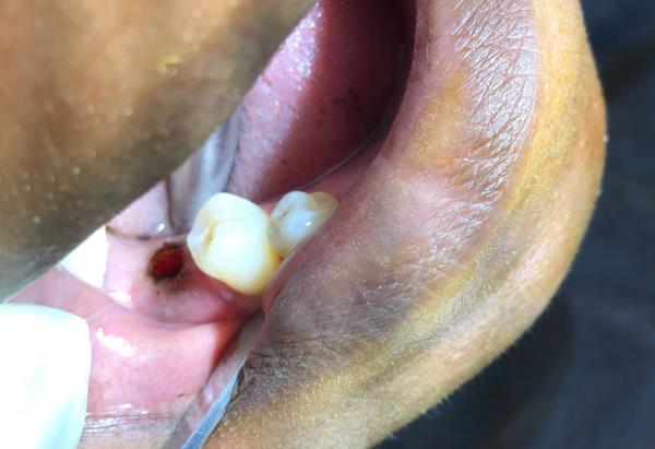 Flapless Implant Placement assisted with Guided Surgery, Coltene's Radio Frequency Device with Colorado Probe and 3D Technology (CBCT - Cone Beam Computed Tomography) By Dr Gaurav Patel