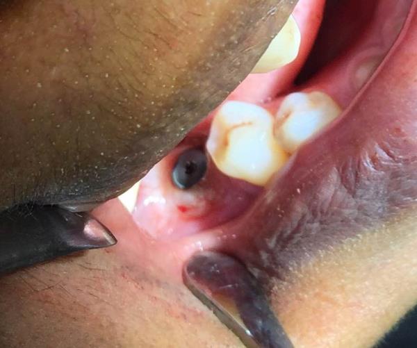 Flapless Implant Placement assisted with Guided Surgery, Coltene's Radio Frequency Device with Colorado Probe and 3D Technology (CBCT - Cone Beam Computed Tomography) by Dr Gaurav Patel