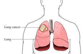 Cancer Hospital in mumbai