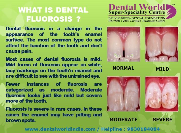 dental fluorosis Dental fluorosis occurs as a result of excess fluoride ingestion during tooth formation enamel fluorosis and primary dentin fluorosis can only occur when teeth are forming, and therefore fluoride exposure (as it relates to dental fluorosis) occurs during childhood. dental fluorosis Dental fluorosis occurs as a result of excess fluoride ingestion during tooth formation enamel fluorosis and primary dentin fluorosis can only occur when teeth are forming, and therefore fluoride exposure (as it relates to dental fluorosis) occurs during childhood.