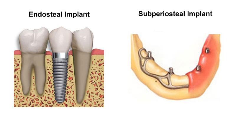 endosteal implant under fontanacountryinn com endosteal implant
