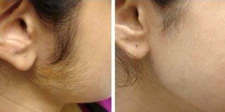 LASER FOR PIGMENTED LESIONS
Pigmented Le
