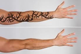 LASER TATTO REMOVAL
A large number of y