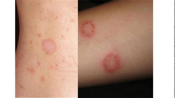 Viral infection is an allergic reaction