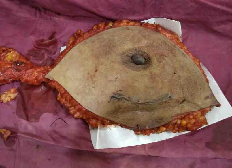 Modified Radical Mastecto