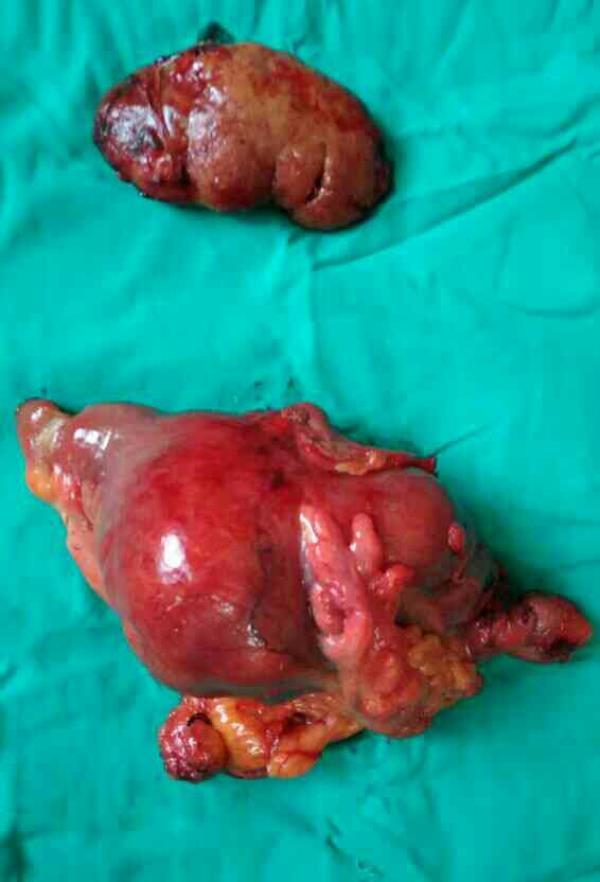GIST tumor and Right Neph