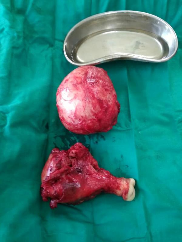 Recently a big intramural fibroid has be