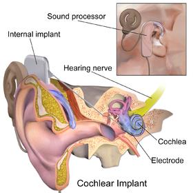 A cochlear implant (