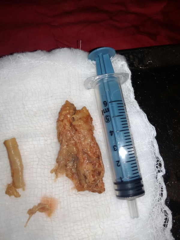 Recently a Big chunk of flesh(foreign bo