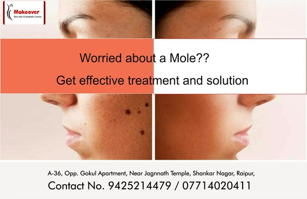 Worried about a mole ???
Get effective t