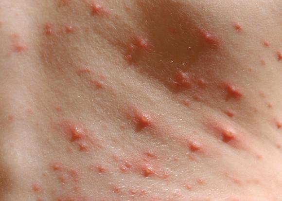 Childhood rashes
Rashes in children are