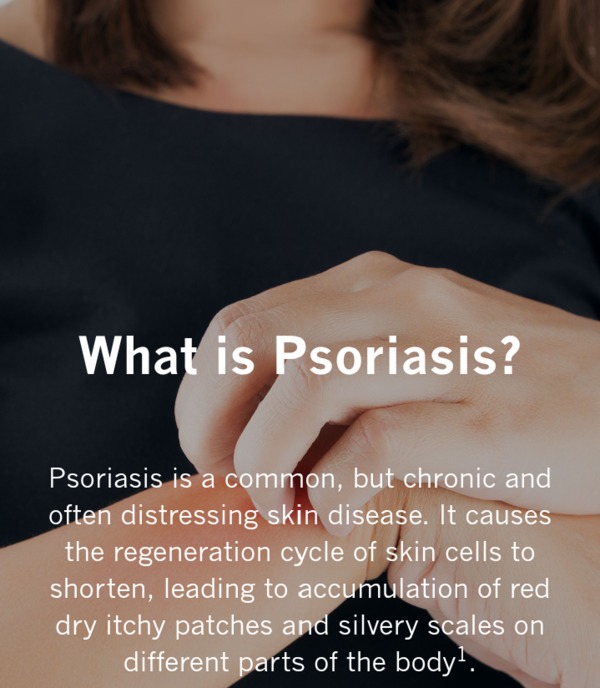 Psoriasis is a common & often distressin
