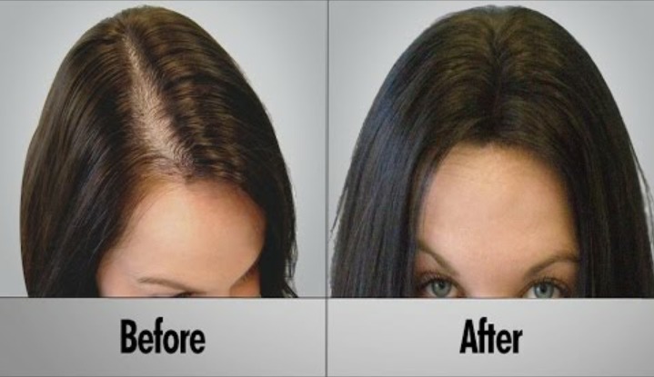 When alopecia areata devlops, the body a