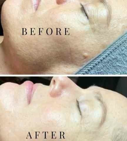 collagen production