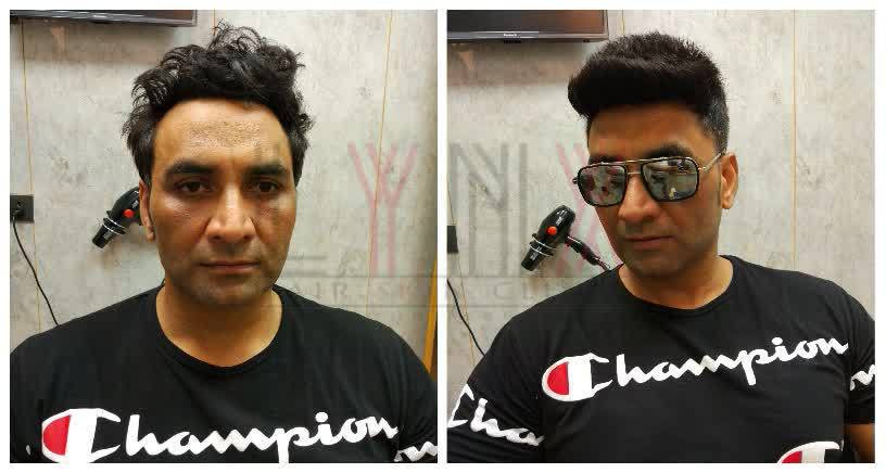 Hair Replacement in Ardee City Gurgaon
