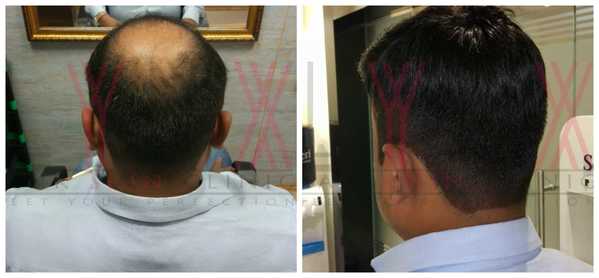 Hair Replacement in Sector 1 Gurgaon 
Ha