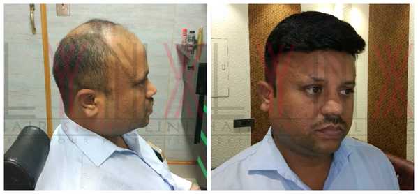 Hair Replacement in Sector 8 Gurgaon 

H