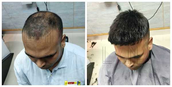 Hair Replacement in Sector 10a Gurgaon 
